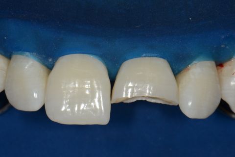 Confecção de Restauração em Resina Utilizando a Matriz Brb