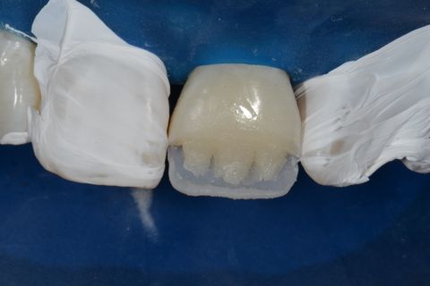 Confecção de Restauração em Resina Utilizando a Matriz Brb