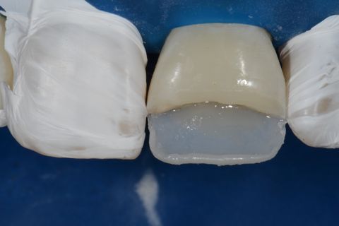 Confecção de Restauração em Resina Utilizando a Matriz Brb