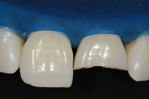 Confecção de Restauração em Resina Utilizando a Matriz Brb