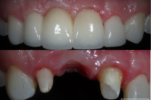 Resultado final, evidenciando a formação das papilas .