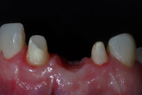 Preparos dos elementos do 21 e do 12.