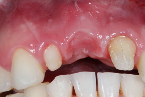 Resultados após condicionamento gengival