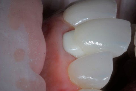 Detalhe para cimentação de faceta sobre zircônia