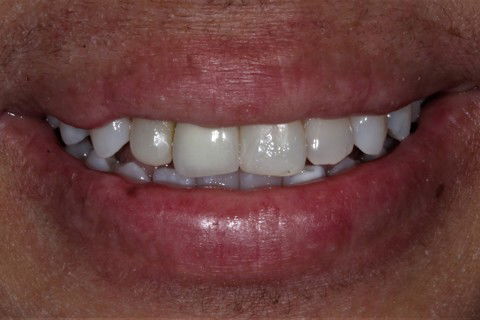 Laminados Cerâmicos Anteriores