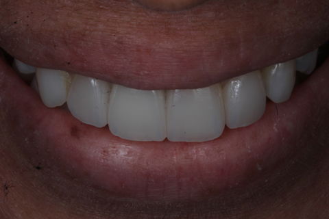 Laminados e coroa cimentados