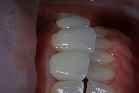 Laminados Cerâmicos Anteriores