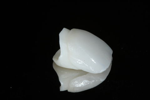 Coroa em zircônia com faceta .