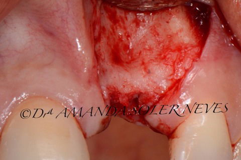 Visualização do defeito ósseo vestibular