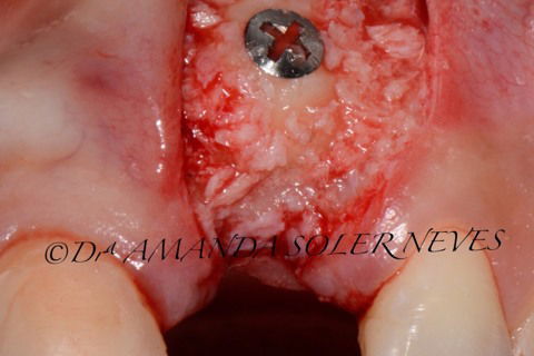 Recobrimento dos 'gaps' com partes do bloco particulado