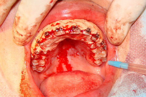Gengivoplastia
