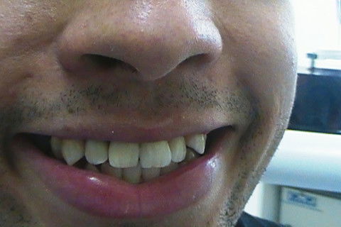 Restaurações em Resina Composta Classe Iii e Iv