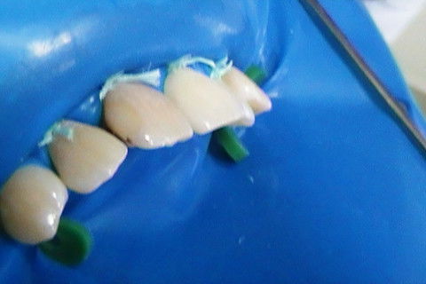 Restaurações em Resina Composta Classe Iii e Iv