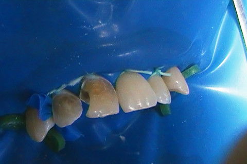 Restaurações em Resina Composta Classe Iii e Iv