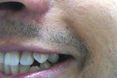 Restaurações em Resina Composta Classe Iii e Iv