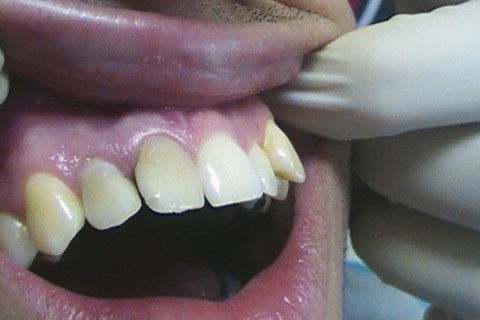 Restaurações em Resina Composta Classe Iii e Iv