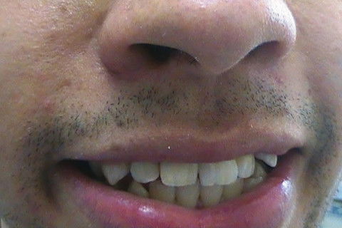 Restaurações em Resina Composta Classe Iii e Iv