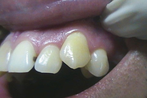 Restaurações em Resina Composta Classe Iii e Iv