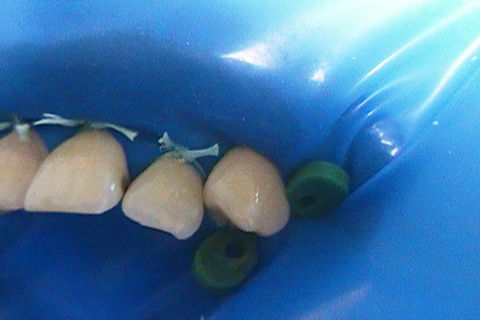 Restaurações em Resina Composta Classe Iii e Iv