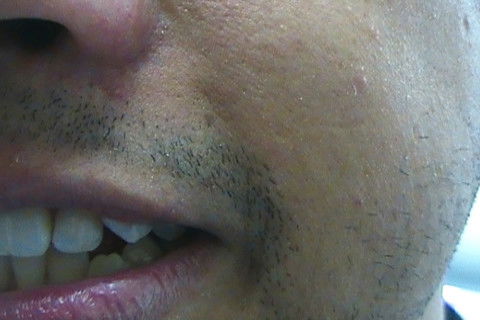 Restaurações em Resina Composta Classe Iii e Iv