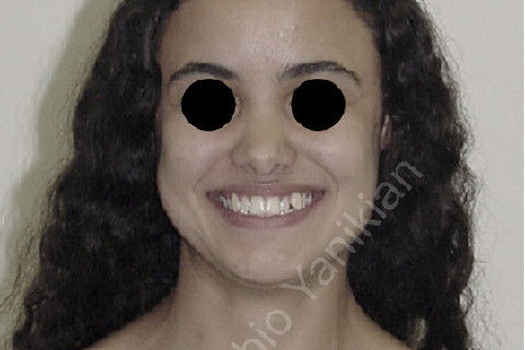 Foto facial sorriso inicial