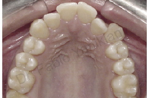 Foto oclusal superior inicial