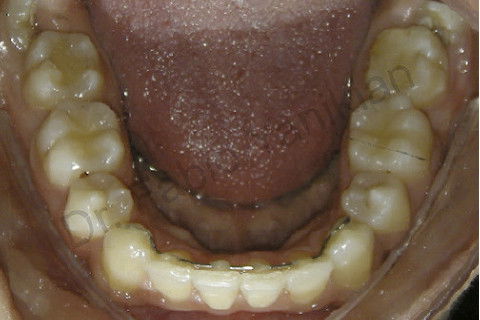 Foto oclusal inferior final
