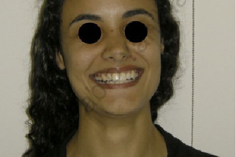 Foto facial sorriso final