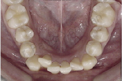 Foto oclusal inferior inicial