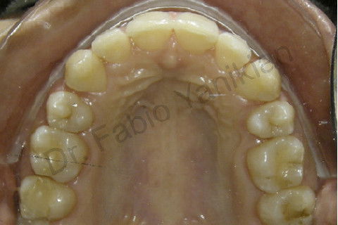 Foto oclusal superior final