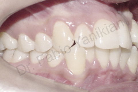 Foto lateral direita inicial