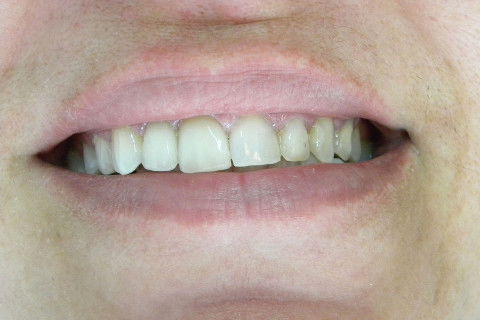 PROVA CERAMICA (antes da plástica gengival)