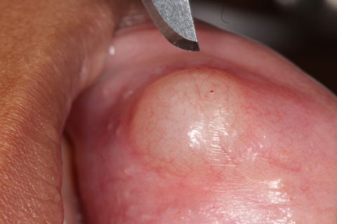 Remoção Cirúrgica de Mucocele