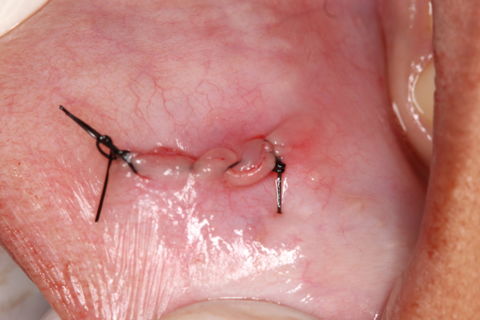 Remoção Cirúrgica de Mucocele