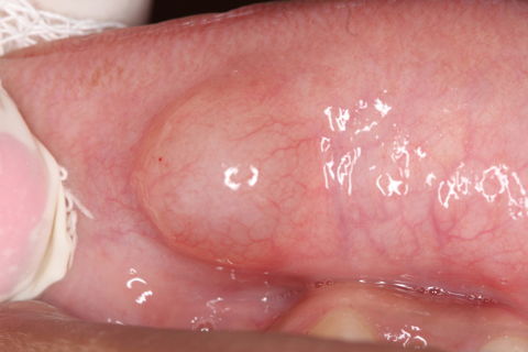 Remoção Cirúrgica de Mucocele