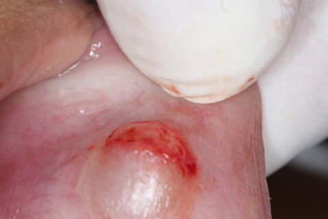 Remoção Cirúrgica de Mucocele