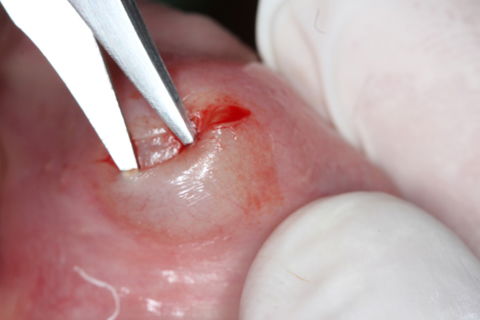 Remoção Cirúrgica de Mucocele