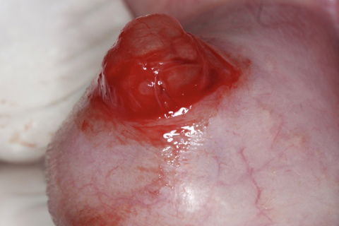 Remoção Cirúrgica de Mucocele