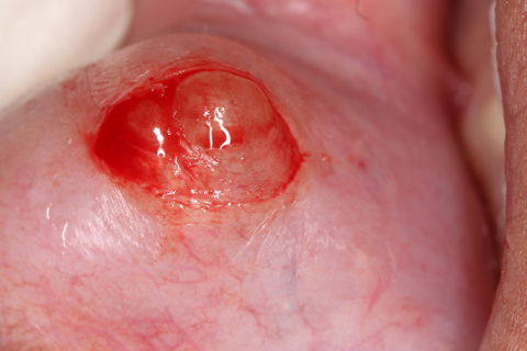 Remoção Cirúrgica de Mucocele