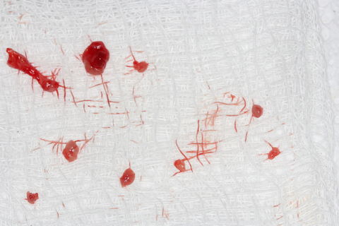 Remoção Cirúrgica de Mucocele