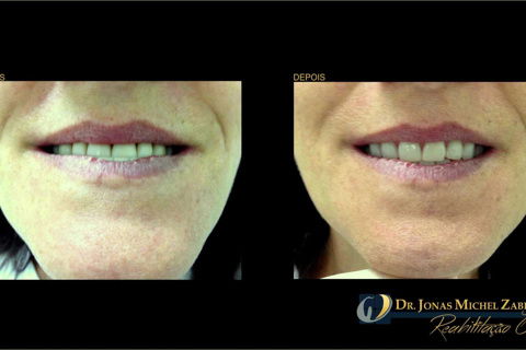 Fotografia mostrando o antes e o depois.