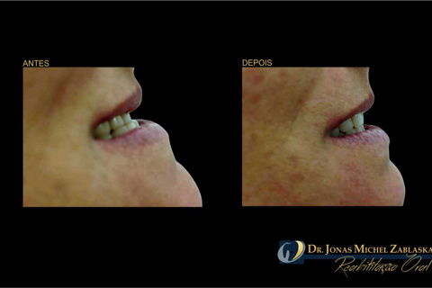 Reabilitação com Próteses Totais Superior e Inferior para Restabelecimento Funcional e Estético