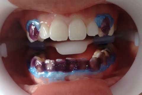 Gel de Peróxido de Hidrogênio 35% após algum tempo de aplicação