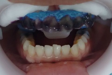 Gel de Peróxido de Hidrogênio 35% após algum tempo de aplicação