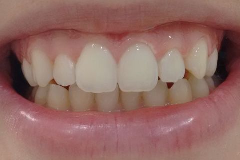 Resultado da sessão do clareamento do arco superior, canino ainda precisa ser clareado para obter cor uniforme com os demais dentes