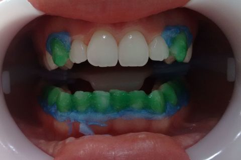 Gel de Peróxido de Hidrogênio 35% após passados 15 min de aplicação