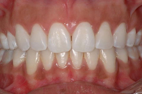 Arcada superior após clareamento e Início do tratamento na arcada inferior.