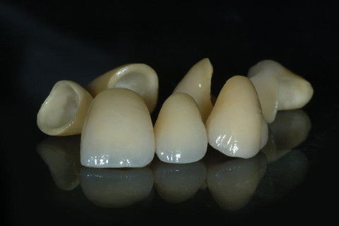 Coroas em cerâmica Vita sobre coping em Alúmina produzidas pelo Laboratório OralArte em Salvador-BA (71-3353-0805)