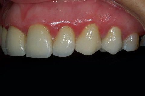 Coroas Cerâmicas como Alternativa Estética para Caso de Alteração Cromática com Tetraciclina.