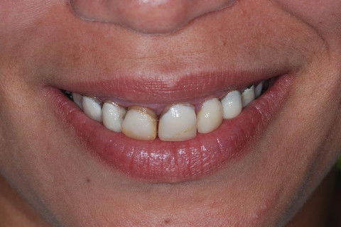 Coroas Cerâmicas como Alternativa Estética para Caso de Alteração Cromática com Tetraciclina.